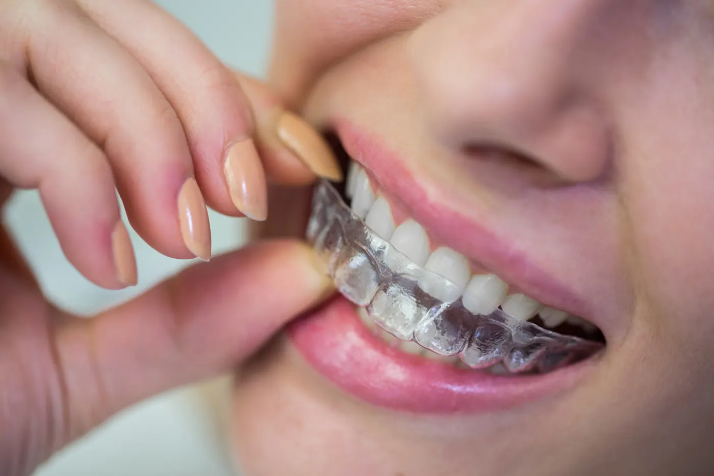Dental Braces Cost in Chennai for Kids