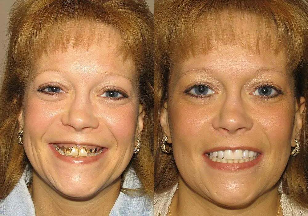 Dental Implant Cost in Chennai Before and After