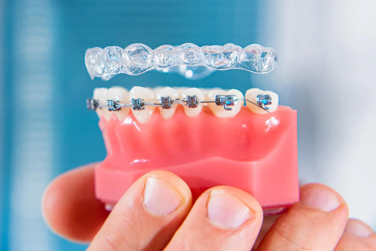 Dental Braces Cost in Chennai EMI Options