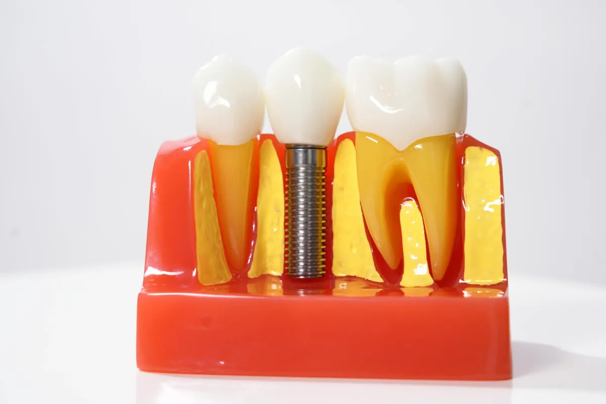 Dental Implant Cost in Chennai EMI Options