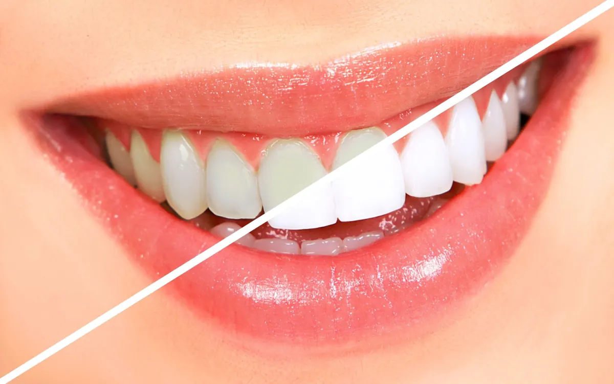 Dental Veneers in Chennai for Kids